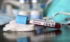 Azərbaycanda aparılmış koronavirus testlərinin sayı 315 mini keçib