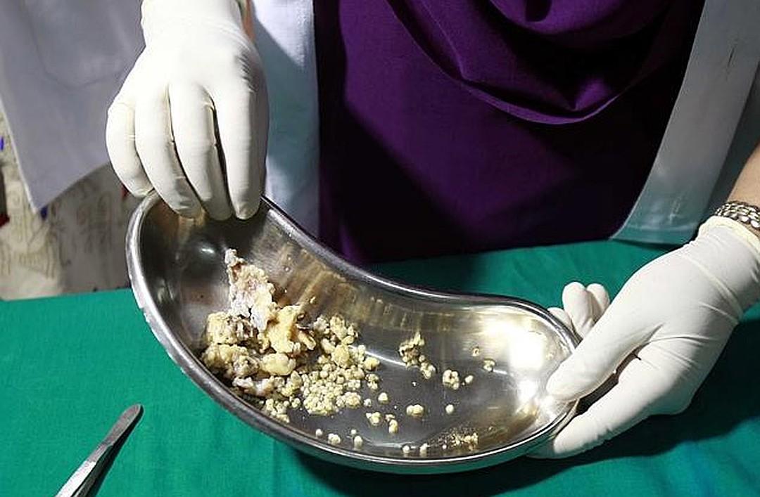 Hindistanda uşağın ağzından 500-dən çox diş çıxarıldı