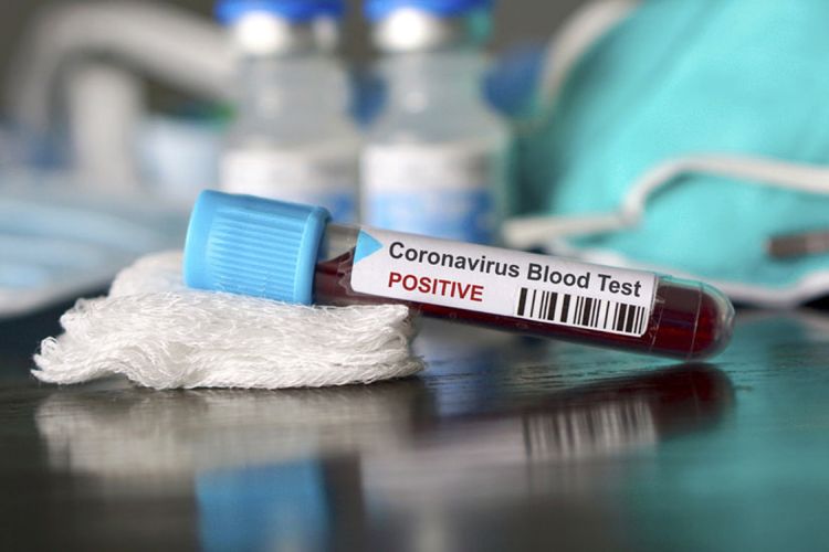 Gürcüstanda koronavirusa yoluxanların sayı 728 nəfərə çatıb
