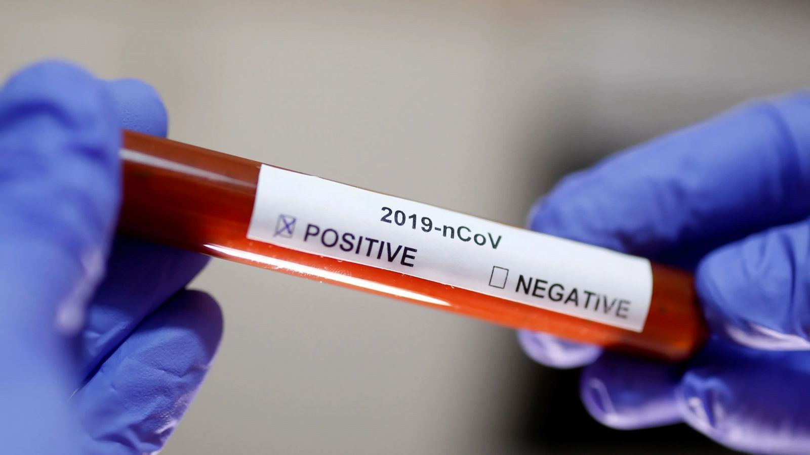 Rusiyada son sutkada koronavirusdan rekord sayda ölüm qeydə alınıb