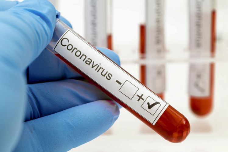 Rusiyada son sutkada 356 nəfər koronavirusdan ölüb
