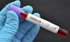 SN: Azərbaycanda COVID-19-a yoluxma halları olsa da, epidemioloji vəziyyət stabildir