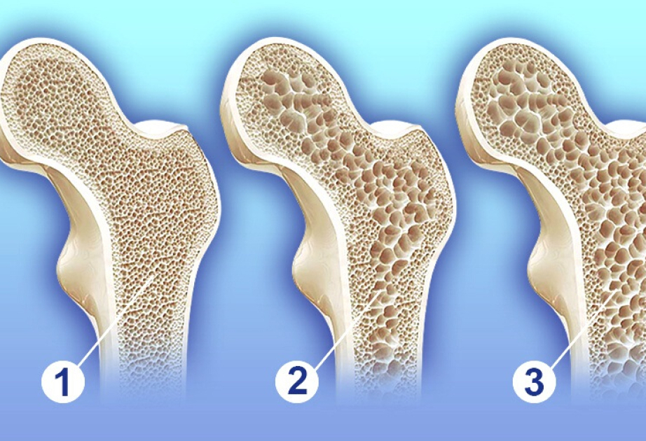 Mütəxəssis: Osteoporoz xəstəliyinin ilkin mərhələsində adətən heç bir əlamət olmur