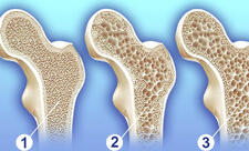 Mütəxəssis: Osteoporoz xəstəliyinin ilkin mərhələsində adətən heç bir əlamət olmur