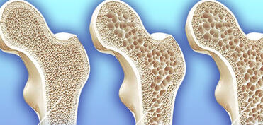 Mütəxəssis: Osteoporoz xəstəliyinin ilkin mərhələsində adətən heç bir əlamət olmur