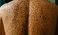 Ganada M çiçəyi virusu yayılmağa davam edir