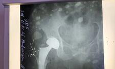 Sabunçu Tibb Mərkəzində süni oynağın qoyulması əməliyyatına başlanılıb