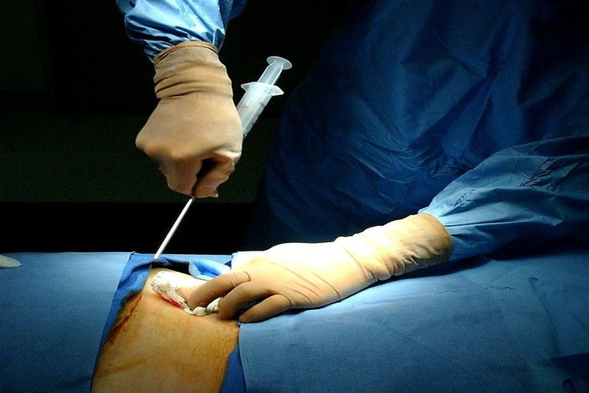 Sümük iliyinin transplantasiyasını həyata keçirəcək xəstəxanaların sayı artırılıb