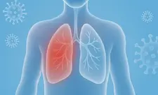 SN: Mövsümi virus infeksiyalarının artması pnevmoniya riskini yüksəldir