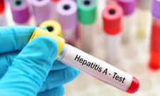 Ölkədə viruslu hepatitlərlə xəstələnmə azalıb